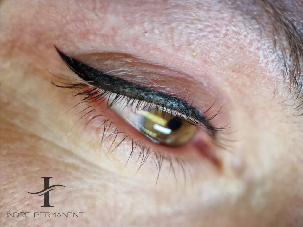 Klasikinė strėlytė ką tik po procedūros